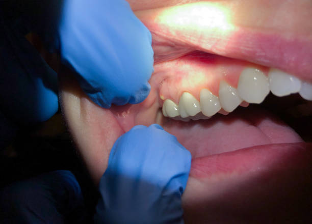 Best Knocked-Out Tooth Emergency  in Hermitage, PA